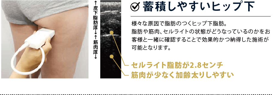 蓄積しやすいヒップ下